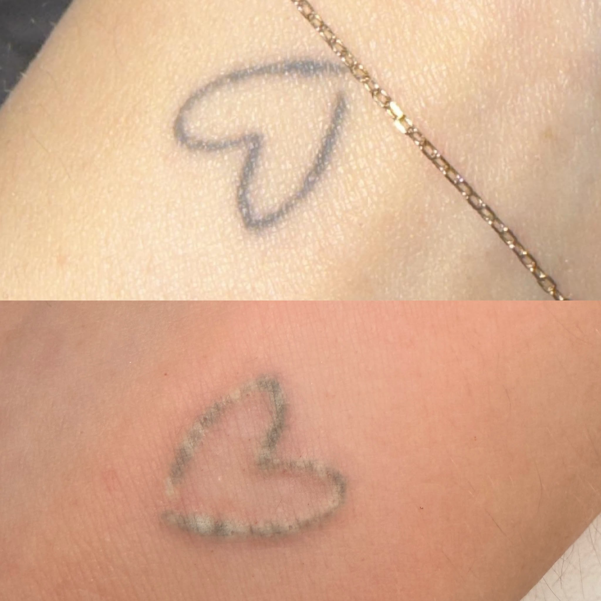 Heart outline tattoo before treatment at the top and eight weeks after one laser session underneath; treatment is ongoing.