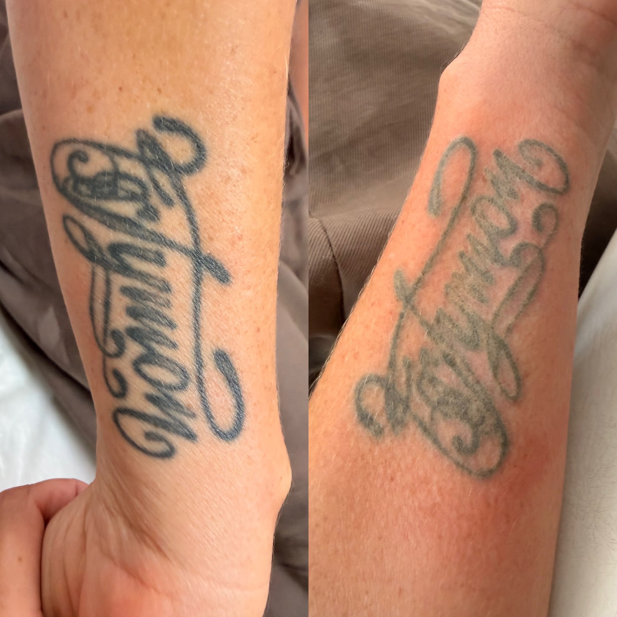 Script tattoo before treatment on the left and eight weeks after one laser session on the right; treatment is ongoing.