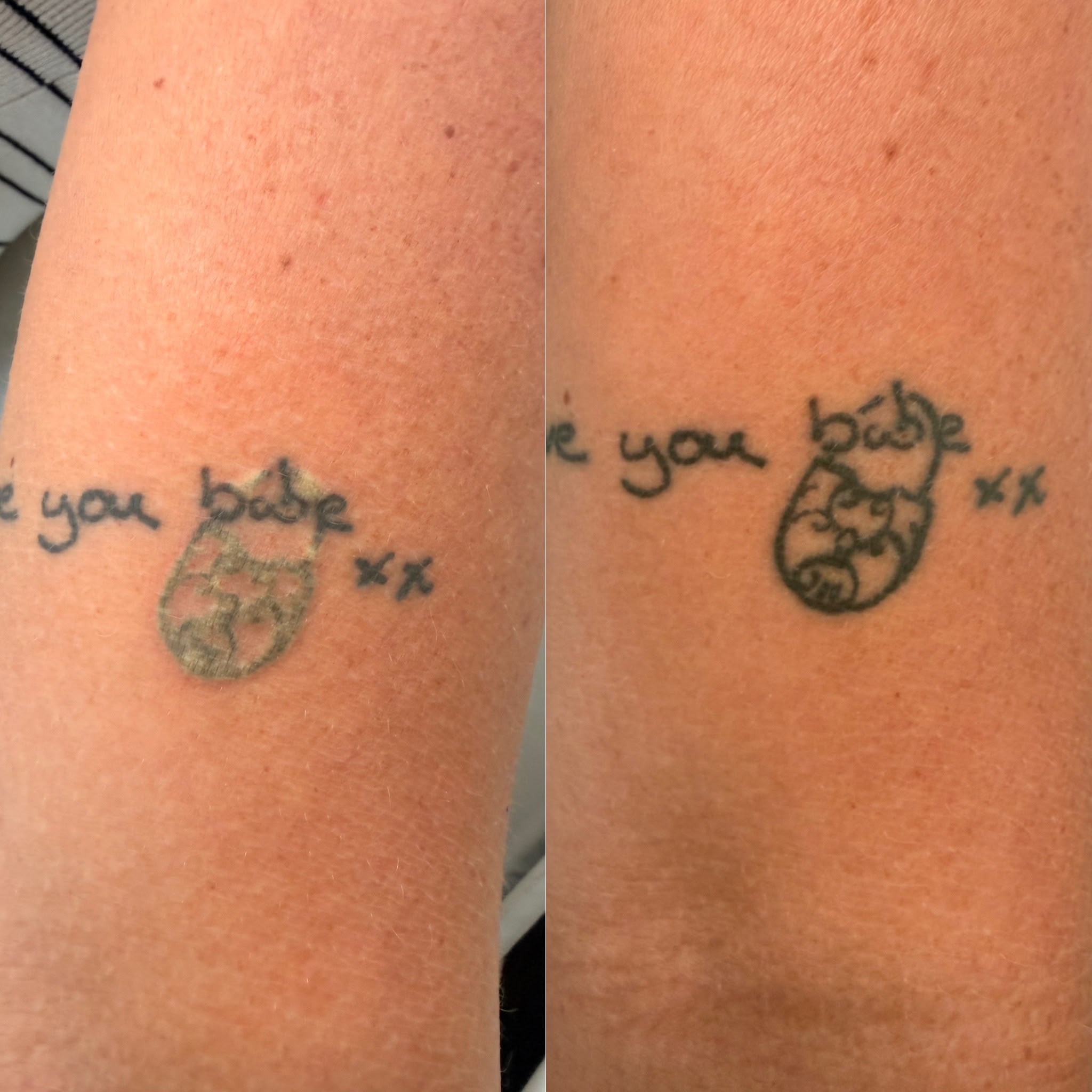 Small character tattoo eight weeks after one laser session on the left, with the before-treatment photograph on the right; treatment is ongoing.