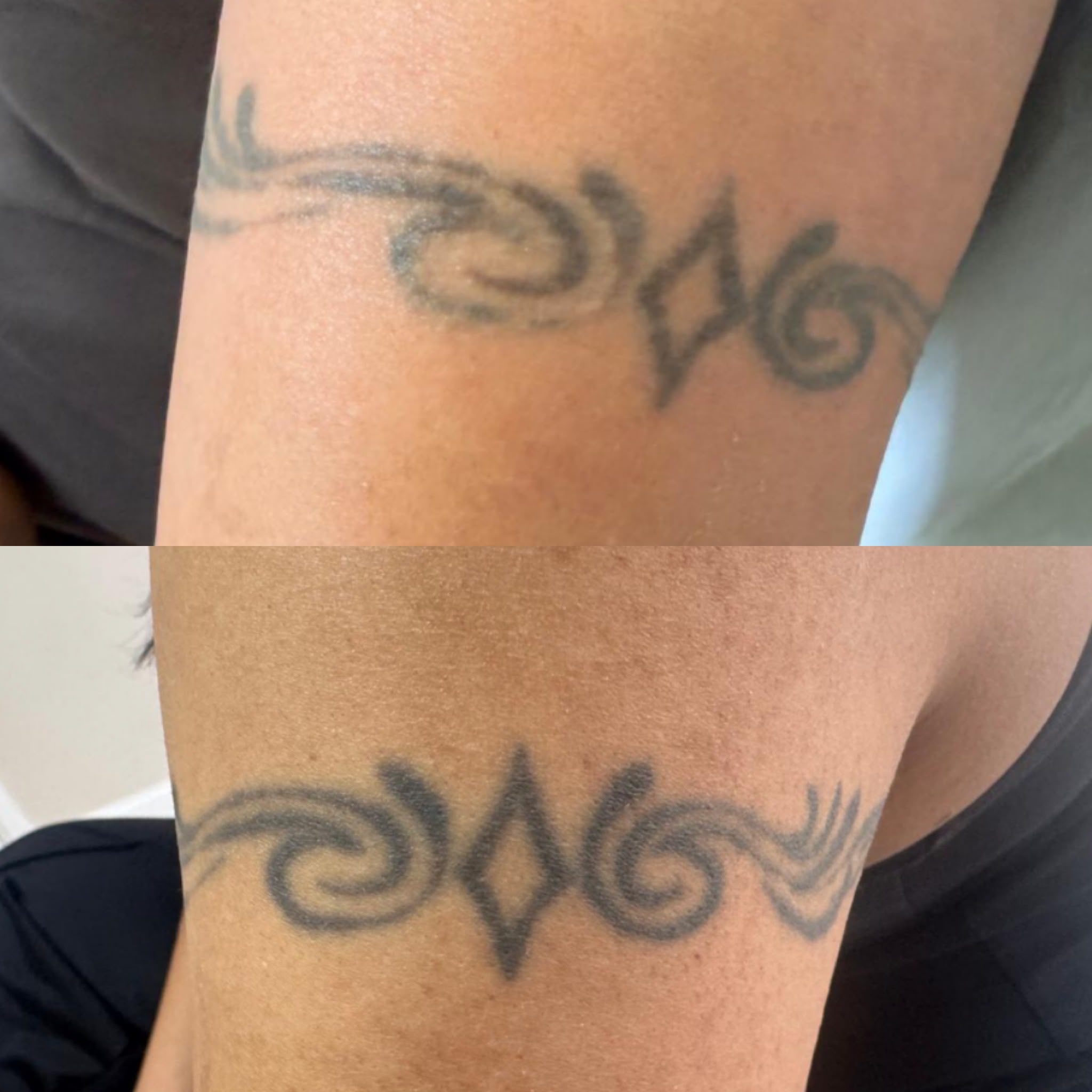 Tribal tattoo eight weeks after one laser session at the top, with the before-treatment photograph underneath; treatment is ongoing.