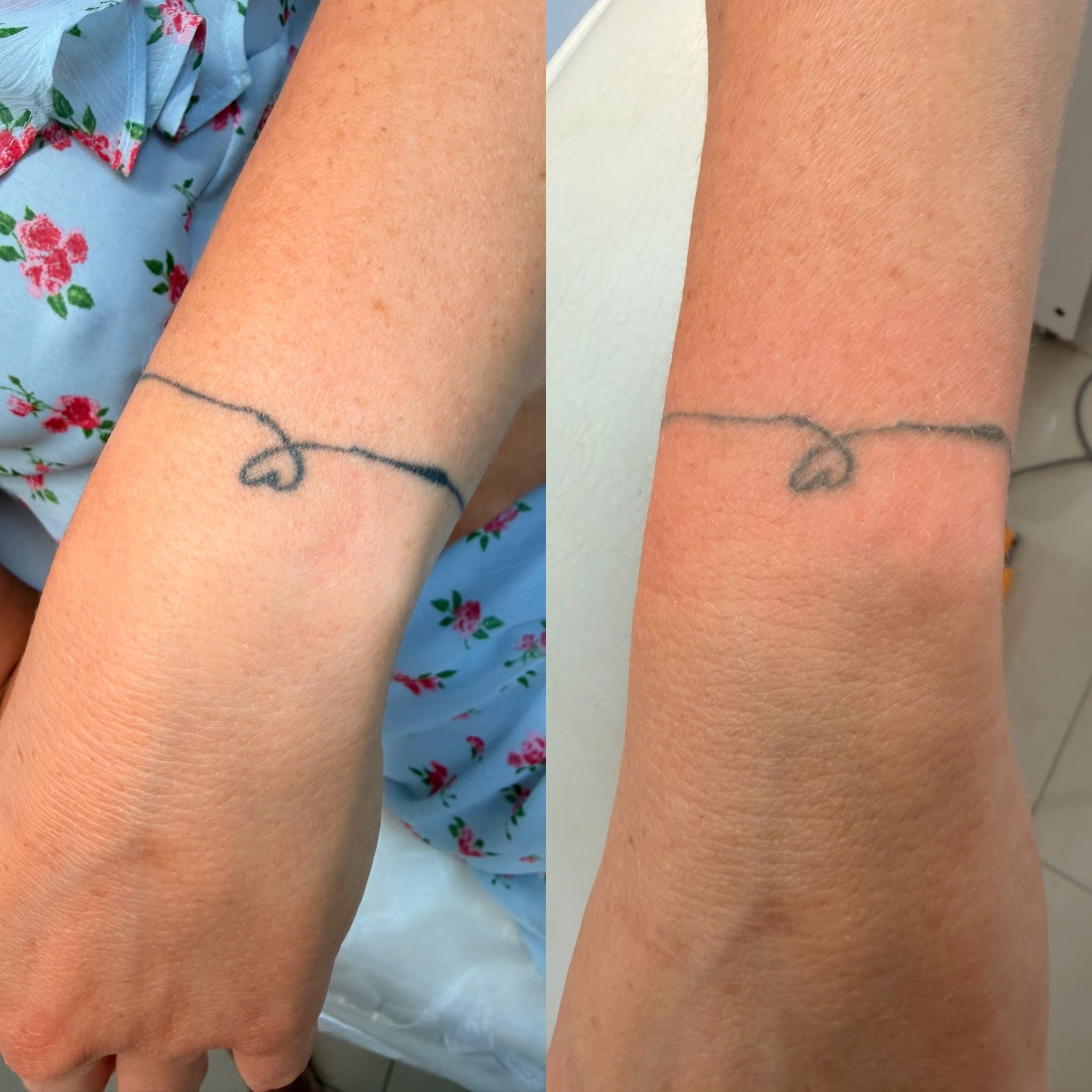 Wrist linework tattoo before treatment on the left and eight weeks after one laser session on the right; treatment is ongoing.